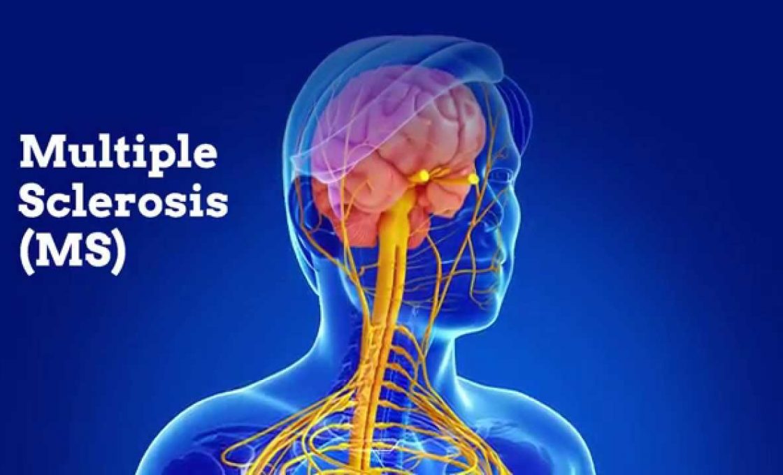 World MS Day –  Multiple Sclerosis Natural Treatment